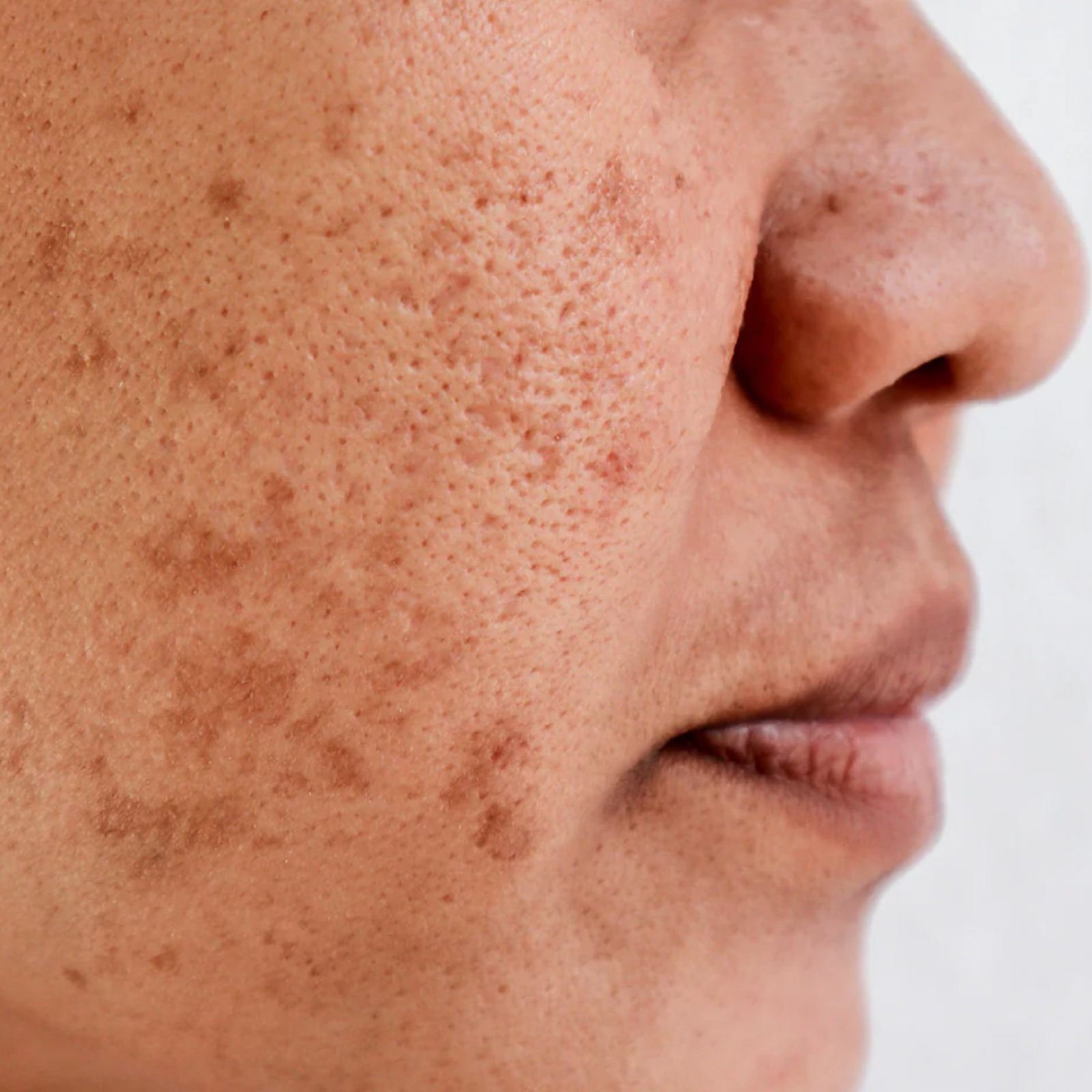 Pigmentation
