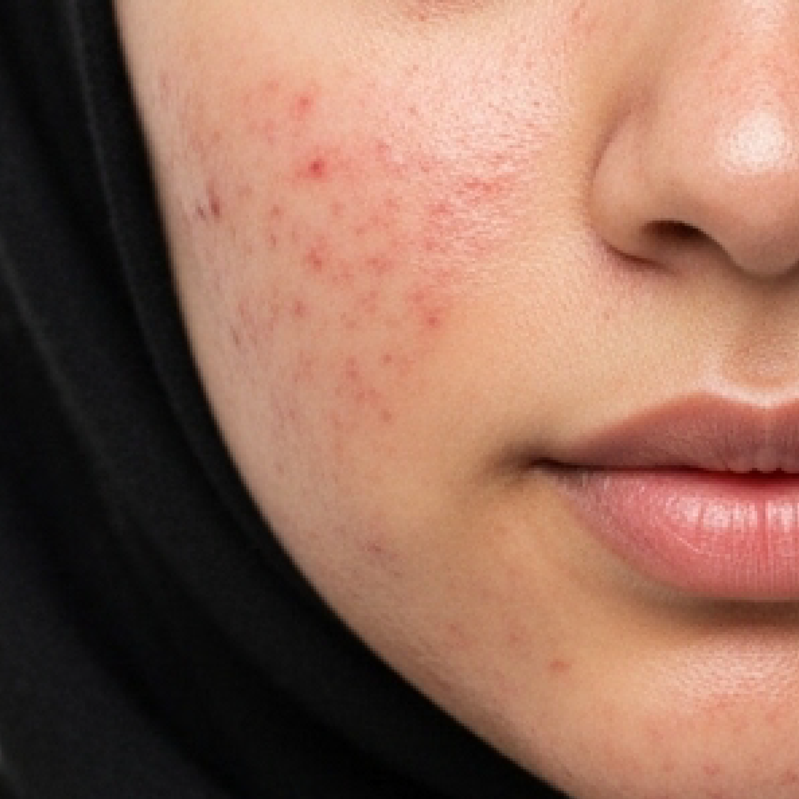 Acne